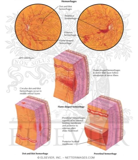 Watermarked preview of labeled image: Hemorrhages