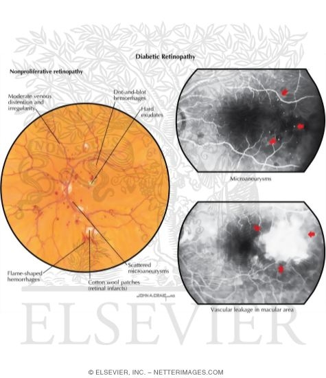 Watermarked preview of labeled image: Diabetic Retinopathy