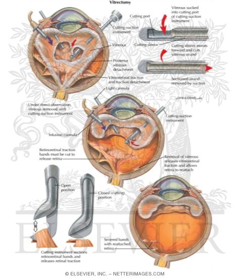 Watermarked preview of labeled image: Vitrectomy