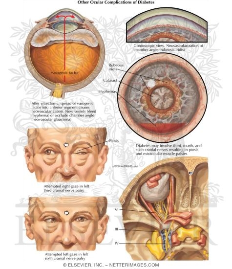 Watermarked preview of labeled image: Other Ocular Complications of Diabetes