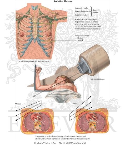 Watermarked preview of labeled image: Radiation Therapy