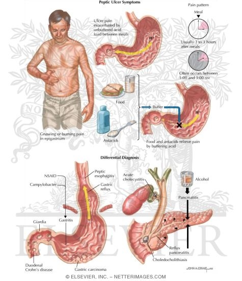 Peptic Ulcer Symptoms and Differential Diagnosis