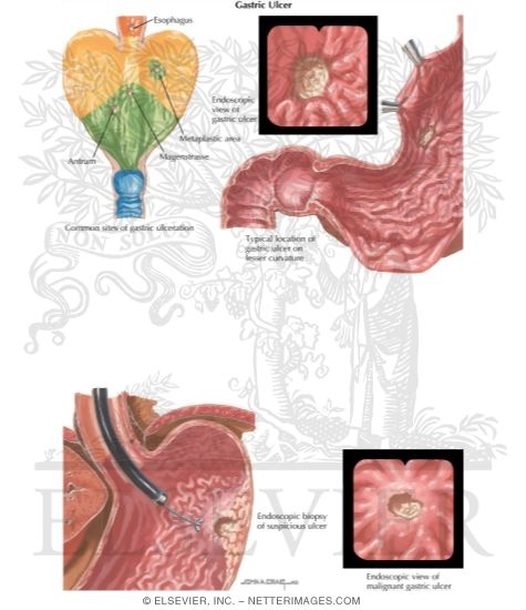 Watermarked preview of labeled image: Gastric Ulcer
