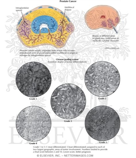 Watermarked preview of labeled image: Prostate Cancer