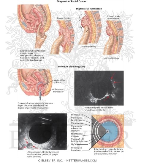 Watermarked preview of labeled image: Diagnosis of Rectal Cancer