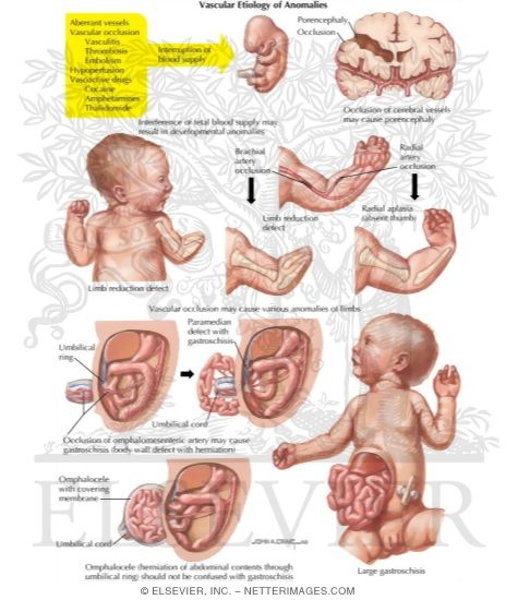 Vascular Etiology of Anomalies