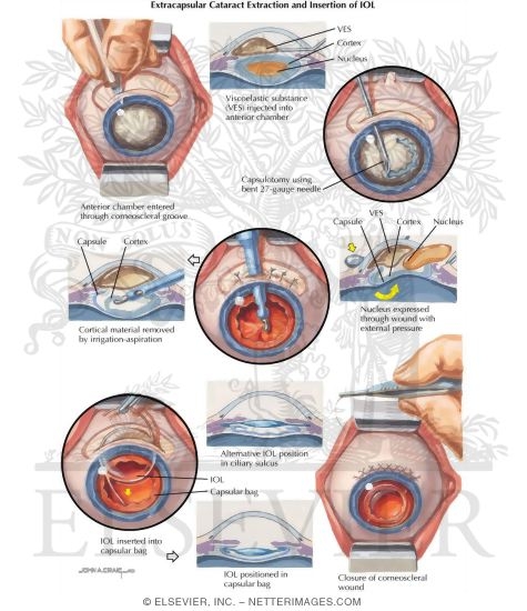 Extracapsular Extraction and Insertion of IOL