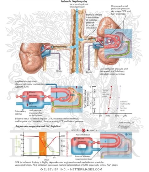 Ischemic Nephropathy