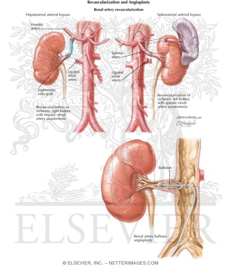 Watermarked preview of labeled image: Revascularization and Angioplasty