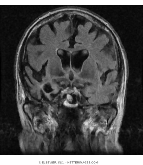 Watermarked preview of unlabeled image: Frontal Temporal Atrophy