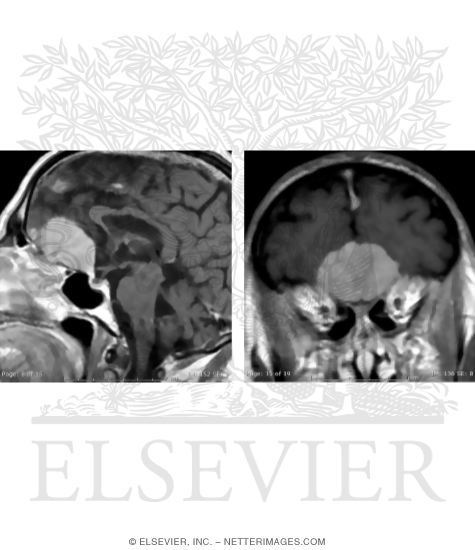 Subfrontal Meningioma