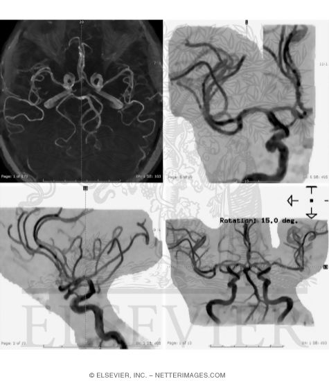 Watermarked preview of unlabeled image: Arterial Imaging With CT and MRI