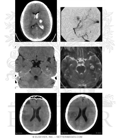 Common Causes of Intracerebral Hemorrhage