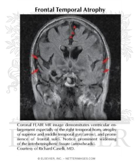 Watermarked preview of labeled image: Frontal Temporal Atrophy