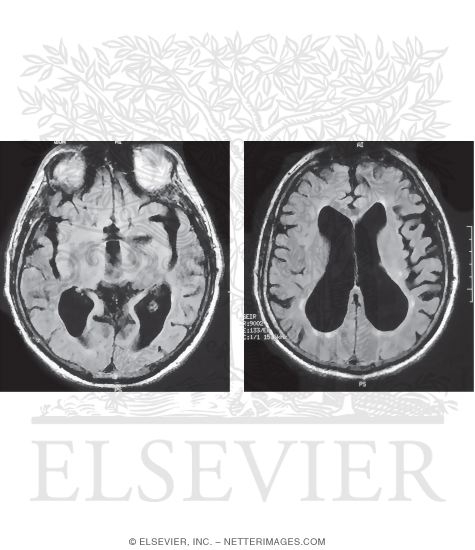 Watermarked preview of unlabeled image: Normal Pressure Hydrocephalus