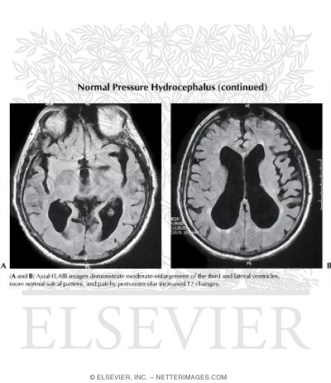 Normal Pressure Hydrocephalus