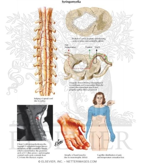 Syringomyelia