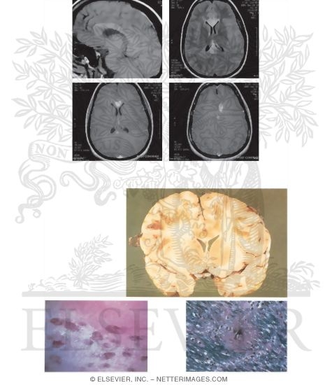 Watermarked preview of unlabeled image: Acute Disseminated Encephalomyelitis