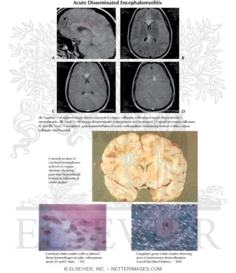 Watermarked preview of labeled image: Acute Disseminated Encephalomyelitis