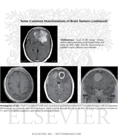 Watermarked preview of labeled image: Some Common Manifestations of Brain Tumors