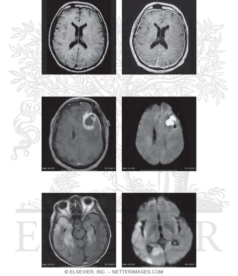 Watermarked preview of unlabeled image: Low-Pressure Headache, Brain Abscess, Herpes Encephalitis