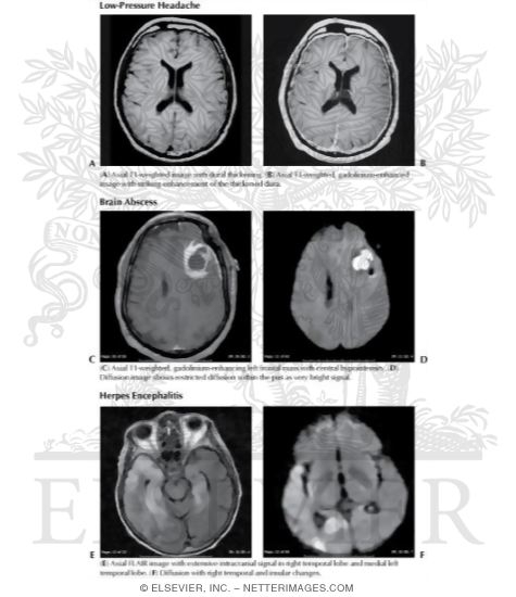 Illustration of Low-Pressure Headache, Brain Abscess, Herpes Encephalitis from the Netter Collection