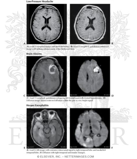 Low-Pressure Headache, Brain Abscess, Herpes Encephalitis