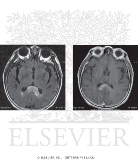 Watermarked preview of unlabeled image: Primary CNS Lymphoma