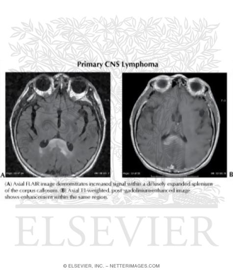 Watermarked preview of labeled image: Primary CNS Lymphoma