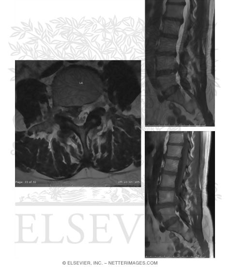L4-5 Disc Extrusion