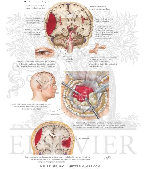 Epidural Hematoma