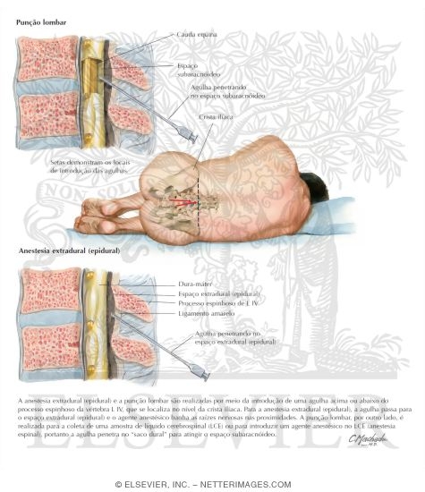 Lumbar Puncture and Epidural Anesthesia