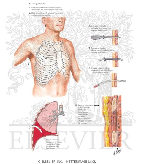 Chest Drainage Tube Placement