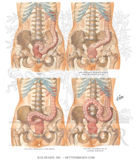 Sigmoid Colon: Variations in Position
Variations of the Sigmoid Flexure