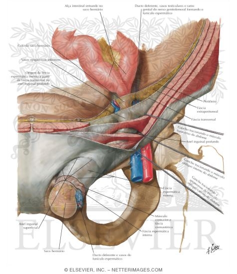 Coverings of Complete Indirect Inguinal Hernia
Hernia I - Indirect and Direct Inguinal Hernias
Indirect Inguinal Hernia