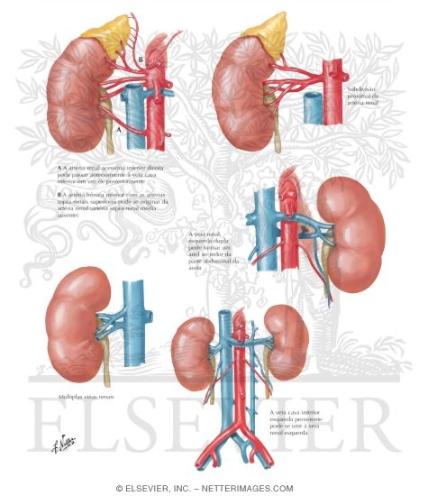 Watermarked preview of labeled image: Renal Vasculature - Variations in Renal Artery and Vein
Variations in Renal Artery and Vein