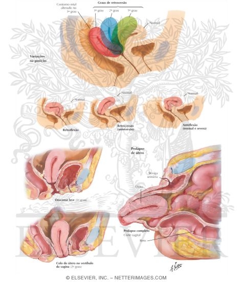Watermarked preview of unlabeled image: Uterus: Position and Prolapse