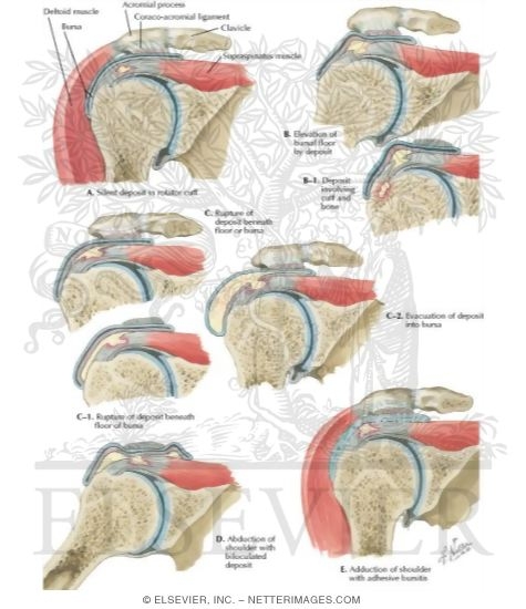 Natural History of Calcified Deposits In Rotator Cuff