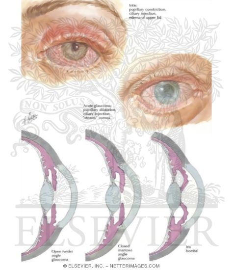 Watermarked preview of labeled image: Iritis, Glaucoma