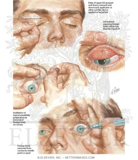 Removal of Foreign Body In the Eye