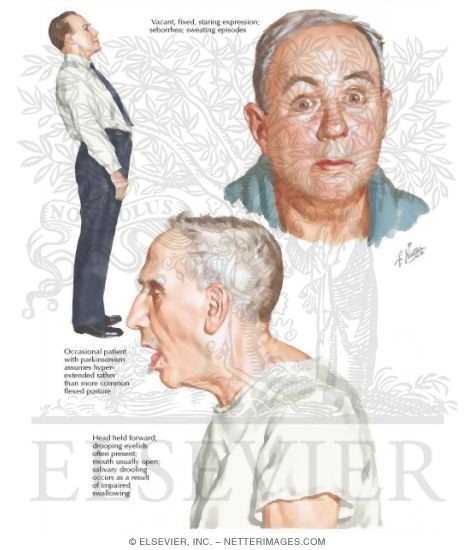 Watermarked preview of labeled image: Parkinsonism