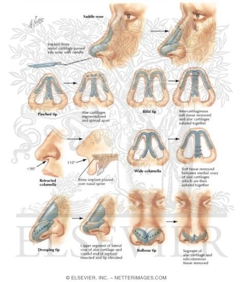 Saddle Nose: Tip Deformities