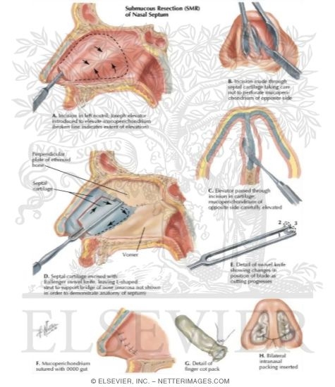 Submucous Resection