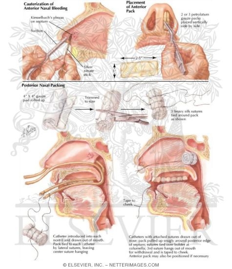 Nasal Bleeding