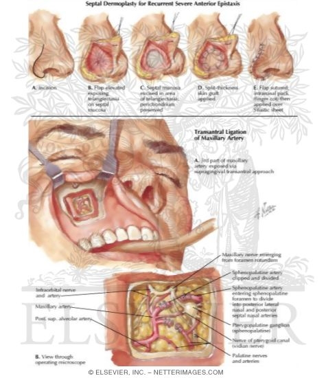 Nasal Bleeding