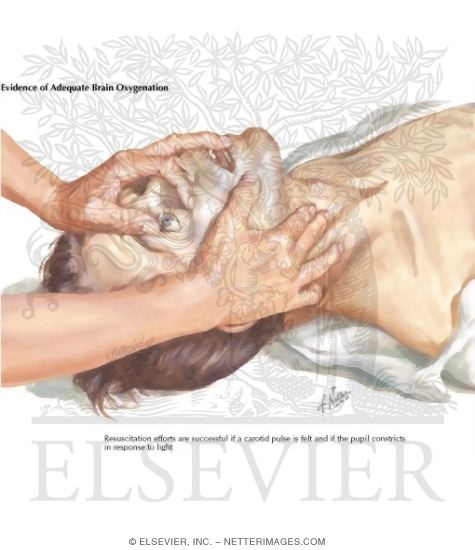 Watermarked preview of labeled image: Pupillary Constriction