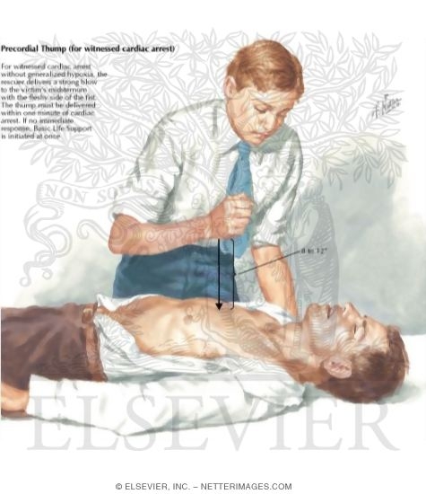 Watermarked preview of labeled image: Precordial Thump