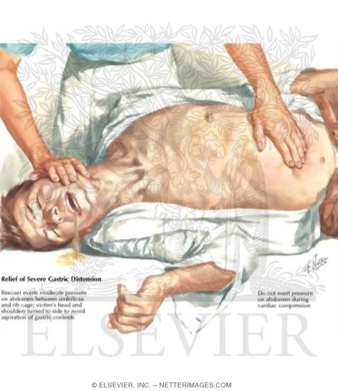 Watermarked preview of labeled image: Relief of Distention