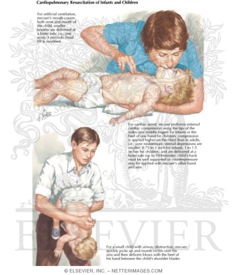 Watermarked preview of labeled image: Heimlich Maneuver: Infant Victim