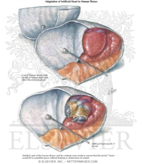 Watermarked preview of labeled image: Conforming Heart Design to the Human Thorax